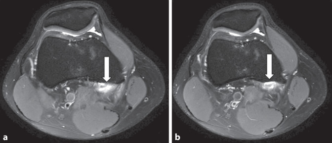 Partial tear of the medial gastrocnemius head : A case report of meniscal symptoms in a 32-year-old recreational athlete.