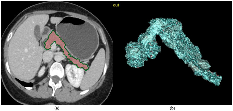 An Investigation of the Relationship Between Pancreas Volume, Nutritional Status, and HbA1c in Geriatric Patients.