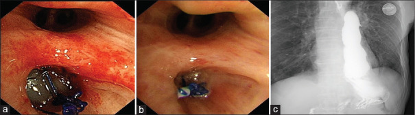 Gastrobronchial fistula after esophageal cancer surgery treated by silicone plug.
