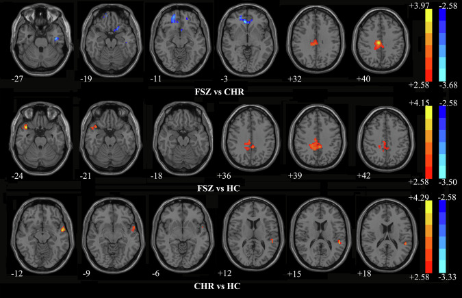 Abnormal eye movement, brain regional homogeneity in schizophrenia and clinical high-risk individuals and their associated gene expression profiles.