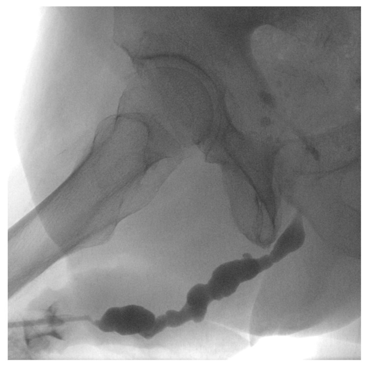 Optilume Drug-Coated Balloon for Acute Urinary Retention After Failed Treatment for Complex Recurrent Urethral Stricture Disease.