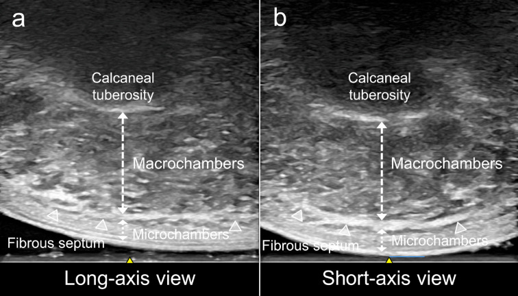 Morphological characteristics of the heel fat pad in the dominant and non-dominant feet under varying loads.