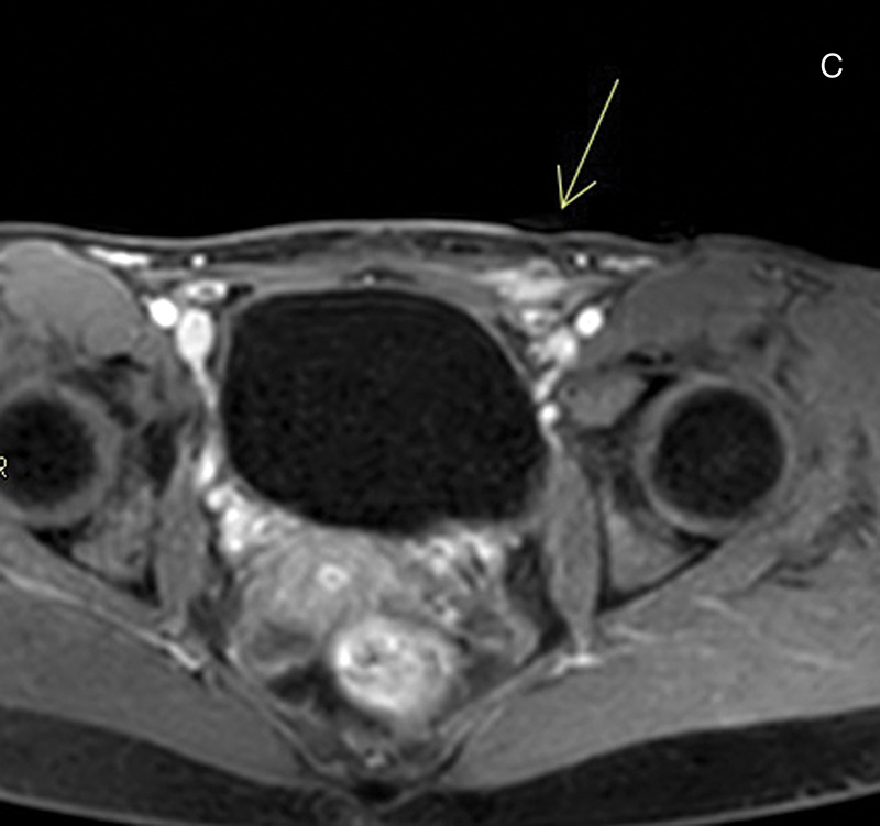 Endometriosis of the Round Ligaments in Twins: A Rare and Unique Presentation.