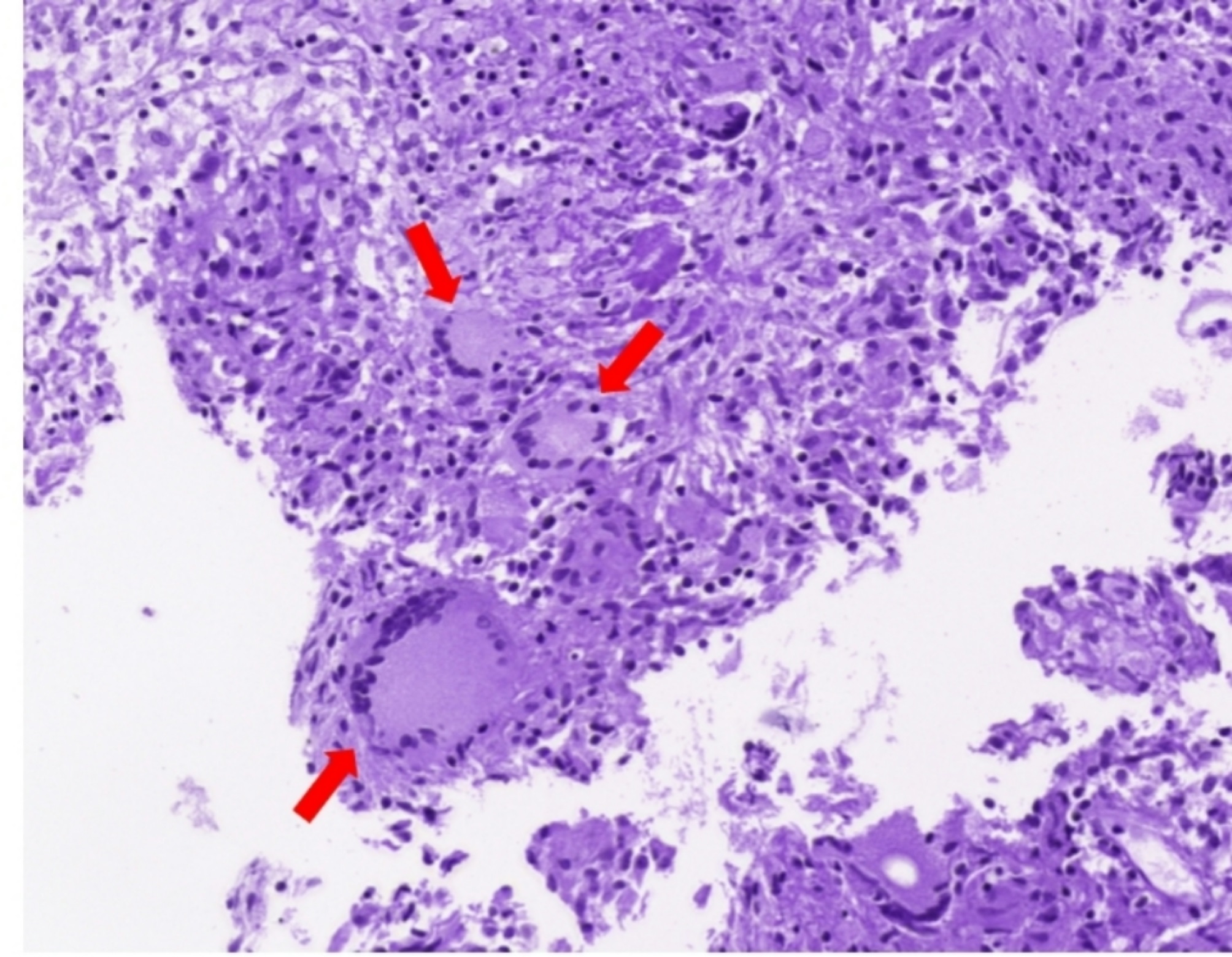 Complete resolution of non-tuberculous mycobacterial pulmonary nodule following cryobiopsy: The first case report.