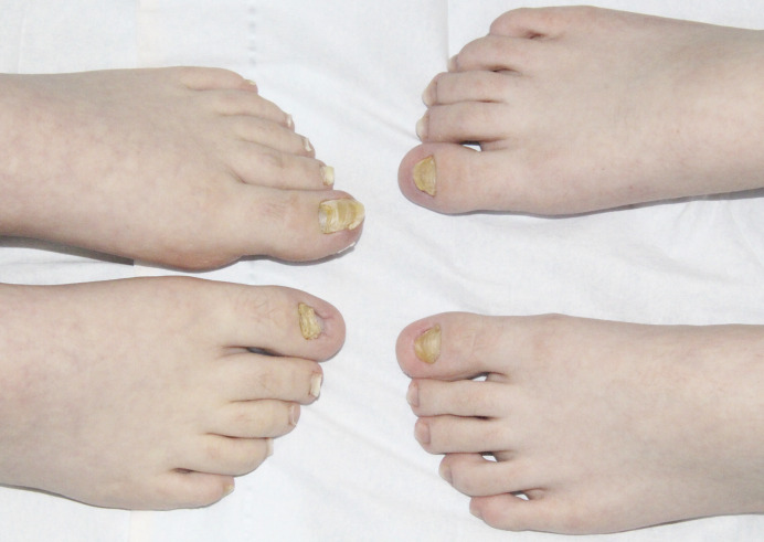 Congenital Malalignment of the Great Toenails with Secondary Retronychia: A Tale of Twin Toenails.