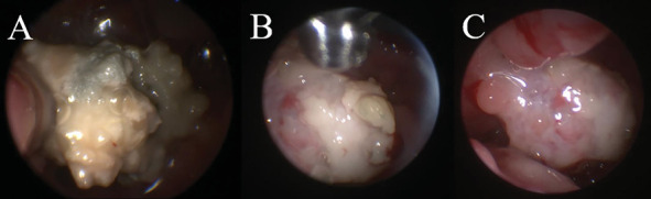 Computed Tomographic and Magnetic Resonance Imaging Diagnosis of Concurrent Sinonasal Aspergillosis and Meningoencephalocele in a Dog.