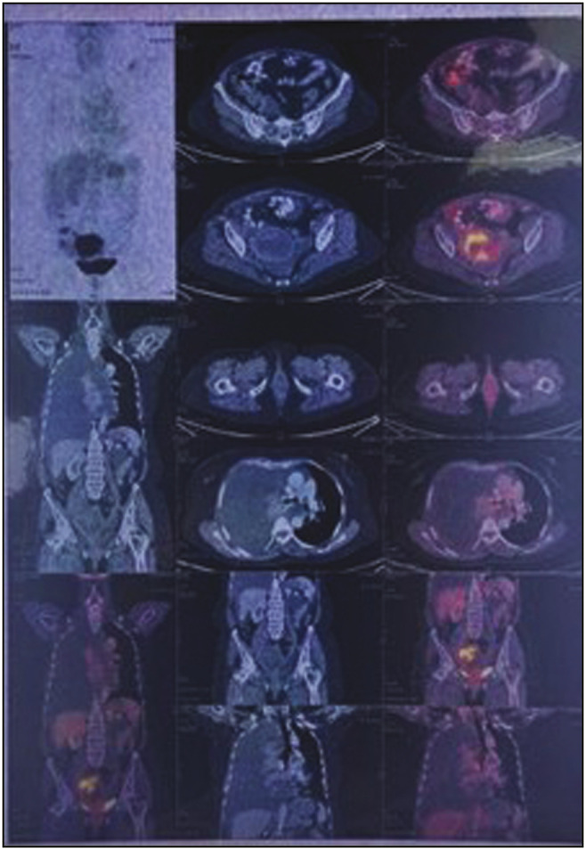 Convention Smears of Pleural Effusion Cytology Revealing Metastatic Clear Cell Carcinoma of Endometrium: A Rare Case Report and Review of Literature.