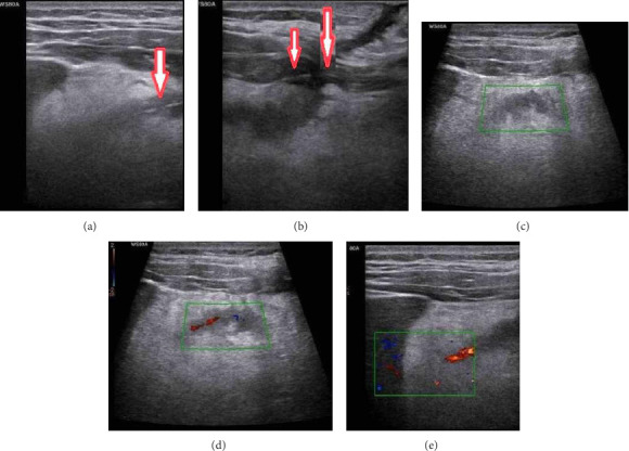 A Diagnostic and Therapeutic Approach to Retained Anchoring Sutures: Color Doppler Ultrasound for Diagnosing and the Retract-and-Cut Technique for Minimizing Invasive Interventions.