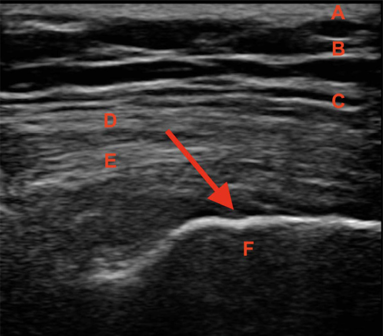 The role of injection collagen therapy in greater trochanter pain syndrome. A new therapeutic approach?