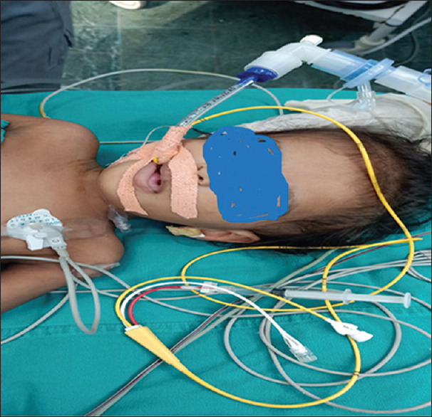 Innovative Use of Pulmonary Artery (PA) Catheter for Lung Isolation in a Pediatric Patient: A Case Report.