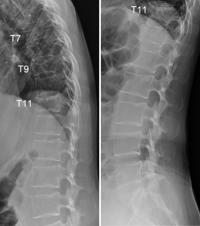 Pregnancy and lactation-related osteoporosis associating multiple vertebral fragility fractures treated with romosozumab: a case report.