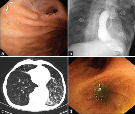 Gastrobronchial fistula after esophageal cancer surgery treated by silicone plug.