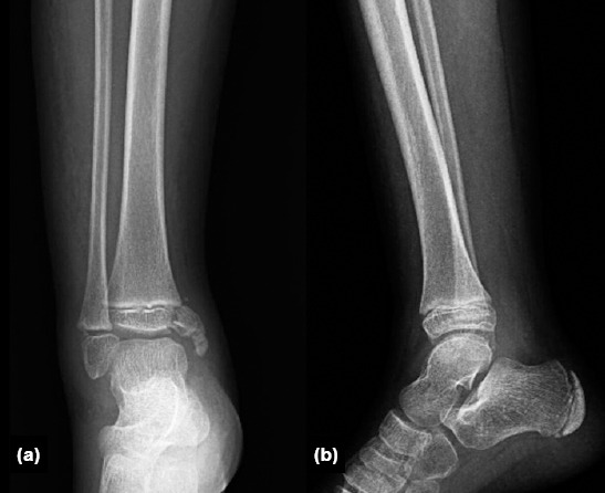 Clinical and radiological outcomes of surgically treated medial malleolus fractures in skeletally immature patients.