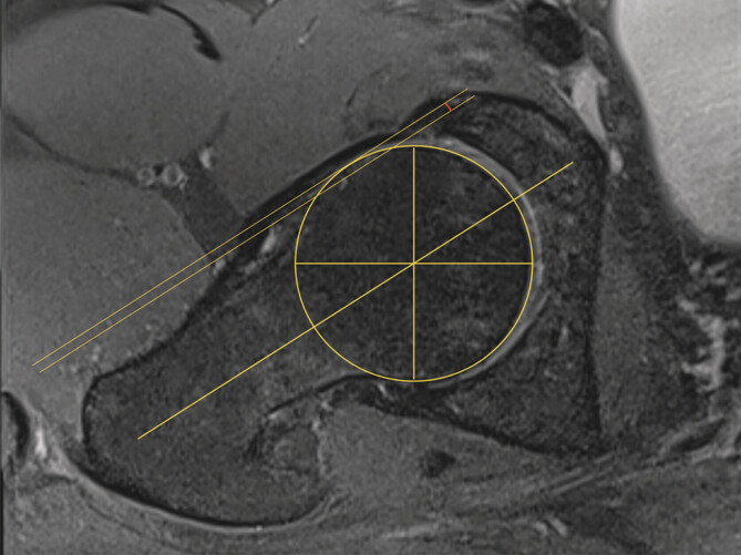 Sonography-based determination of hip joint anterior head-neck offset is reliable and reproducible for CAM deformity assessment.