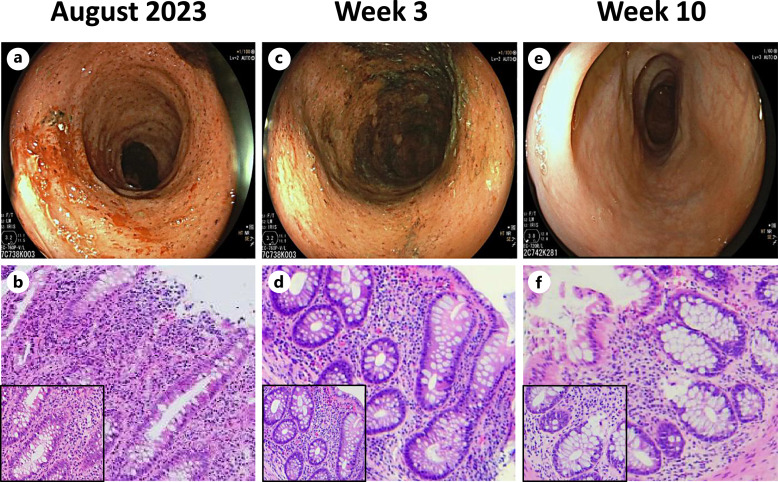 Filgotinib to Treat Acute Severe Refractory Ulcerative Colitis: A Case Report and Review of the Literature.