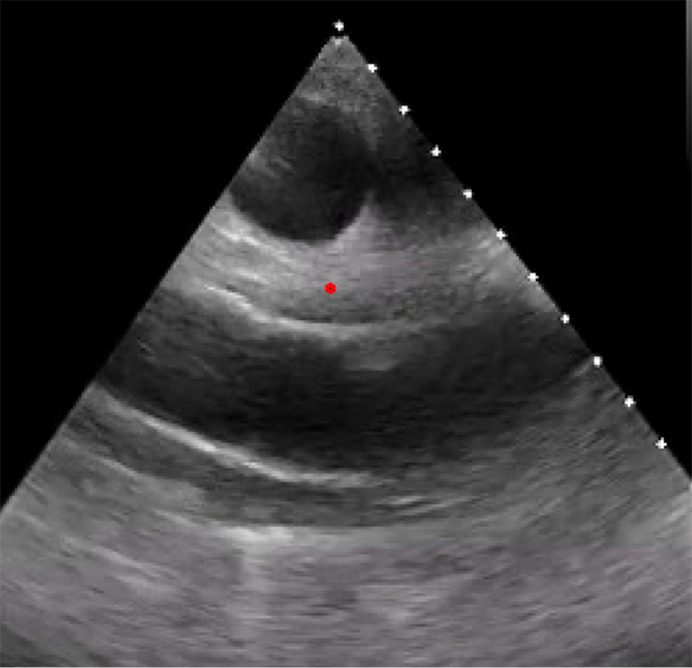 Applications of multi-modality imaging in the diagnosis of infective endocarditis: a real-life case based contemporary narrative review.