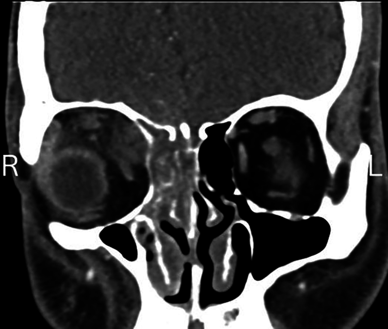 Preoperative Administration of Amphotericin B in Orbital Mucormycosis Management: A Case Report.