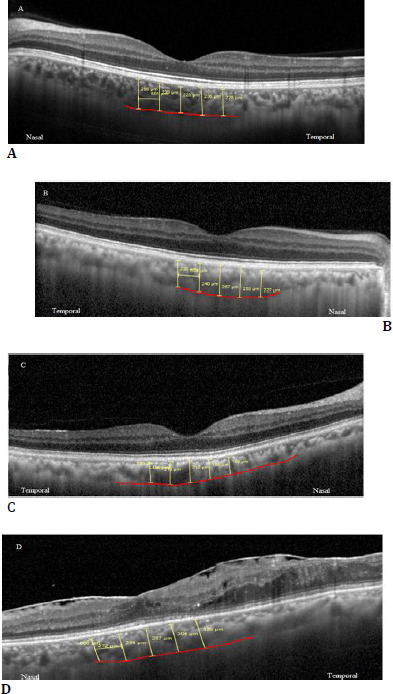 Evaluation of Choroidal Thickness in Type 2 Diabetes Using Spectral-Domain Optical Coherence Tomography.