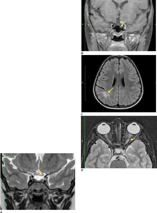 Neurological and neurosurgical conditions presenting first with ophthalmological clinical features: A case series.