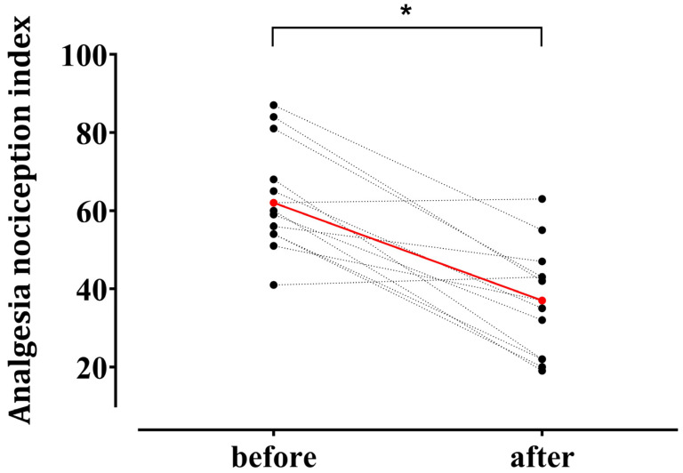 The Analgesia Nociception Index's Performance During Remimazolam-Based General Anesthesia: A Prospective Observational Study.