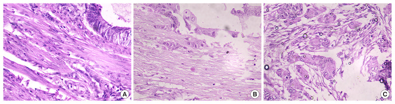 Prognostic significance of tumor budding in endometrial cancer: clinicopathological insights.