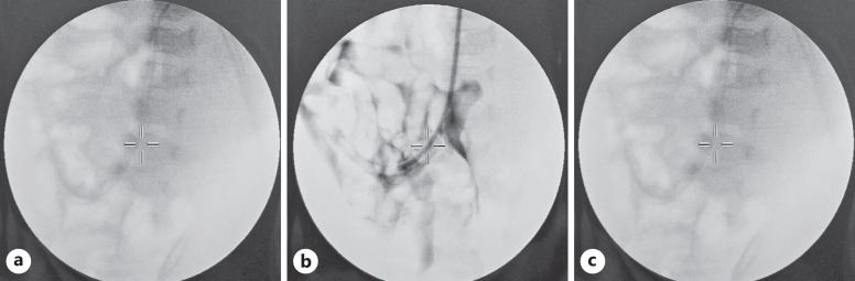 Peritoneal Dialysis Catheter Malfunction due to Adhesion to Ileum: A Case Report.