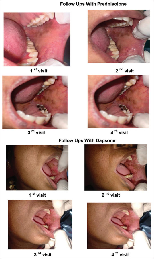 Therapeutic efficacy of steroids versus non-steroidal agents in the treatment of oral lichen planus: A randomised control study.
