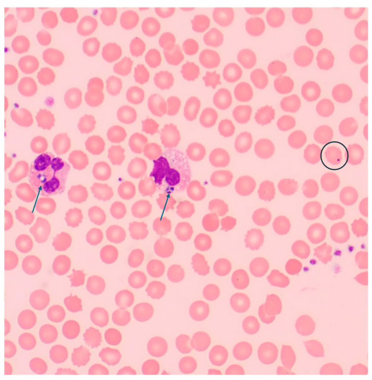 Severe Anaplasmosis with Multi-Organ Failure in a Patient with Splenectomy: A Case Report.