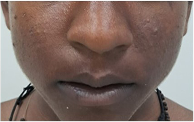 Precocious puberty in male with hypertension and hypokalemia; a definite diagnostic clue for 11β hydroxylase deficiency CAH.