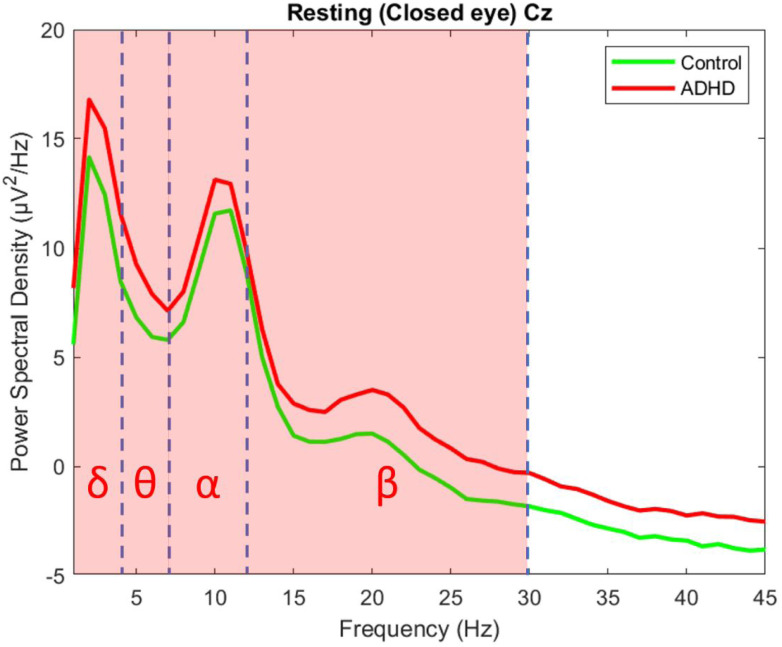 An Electroencephalography Study of Adult Attention Deficit Hyperactivity Disorder and its Association with Insomnia.