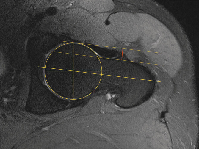Sonography-based determination of hip joint anterior head-neck offset is reliable and reproducible for CAM deformity assessment.