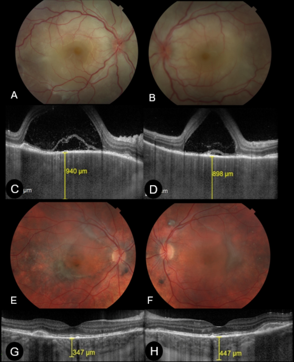 Bacillary layer detachment in acute Vogt-Koyanagi-Harada disease: an early predictor of long-term complications in a Brazilian cohort.