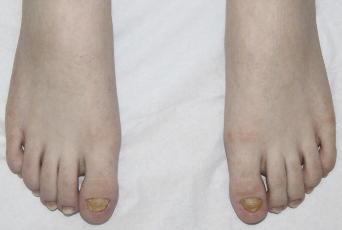 Congenital Malalignment of the Great Toenails with Secondary Retronychia: A Tale of Twin Toenails.