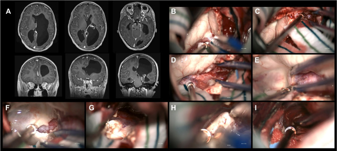 Two-year outcomes following modified transsylvian peri-insular hemispherotomy.