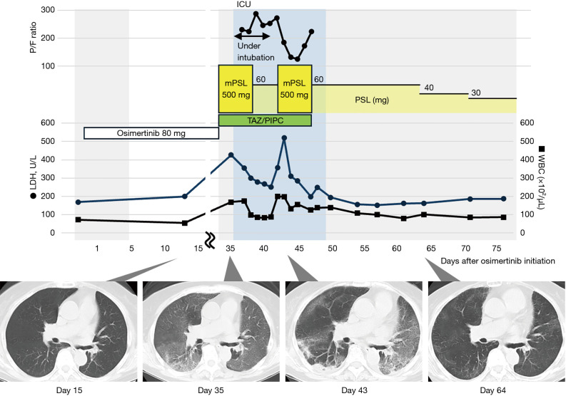 Life-threatening interstitial lung disease with adjuvant osimertinib after complete resection of non-small cell lung cancer: a case report.