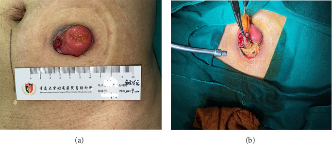 Radiation-Induced Fibrosarcoma in the Stoma: A Case Report and Literature Review.