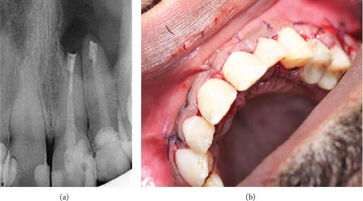 Healing of Extensive Through-and-Through Periradicular Lesion Using Apicoectomy Without Bone Grafting: A Case Report With 3-Year Recall.