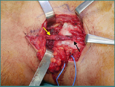 Functional outcomes following nerve transfers for shoulder and elbow reanimation in brachial plexus injuries: a 10-year retrospective study.