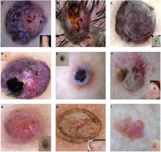 Dermoscopic Features of Eccrine Poromas in Diverse Skin Phototypes: A Retrospective Study of 26 Cases.