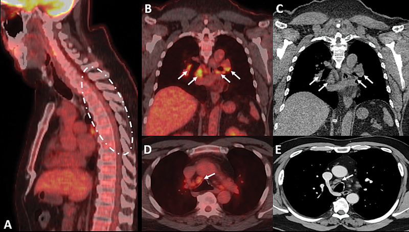 Pointing the trident in the right direction: recognizing spinal neurosarcoidosis through a specific MRI pattern.