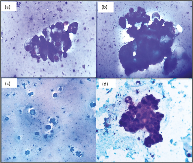 Convention Smears of Pleural Effusion Cytology Revealing Metastatic Clear Cell Carcinoma of Endometrium: A Rare Case Report and Review of Literature.