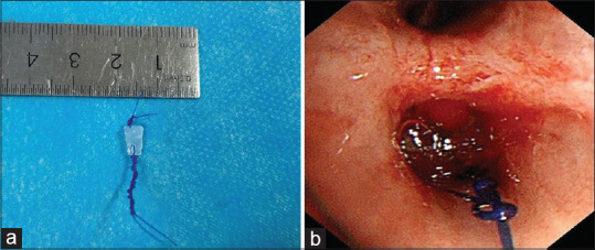 Gastrobronchial fistula after esophageal cancer surgery treated by silicone plug.
