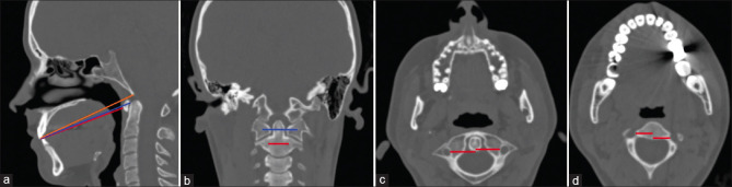 Morphometric analysis of some important parameters for the transoral approach to the occipito-atlanto-axial region: MDCT study.