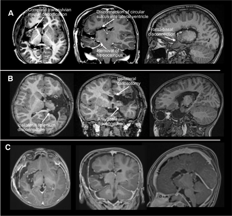 Two-year outcomes following modified transsylvian peri-insular hemispherotomy.
