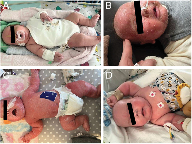 Necrolytic migratory erythema following prolonged continuous subcutaneous dasiglucagon administration: a rare dermatologic adverse event.