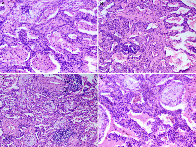 Acute fibrinous and organising pneumonia presenting with mass-like imaging: a case report.