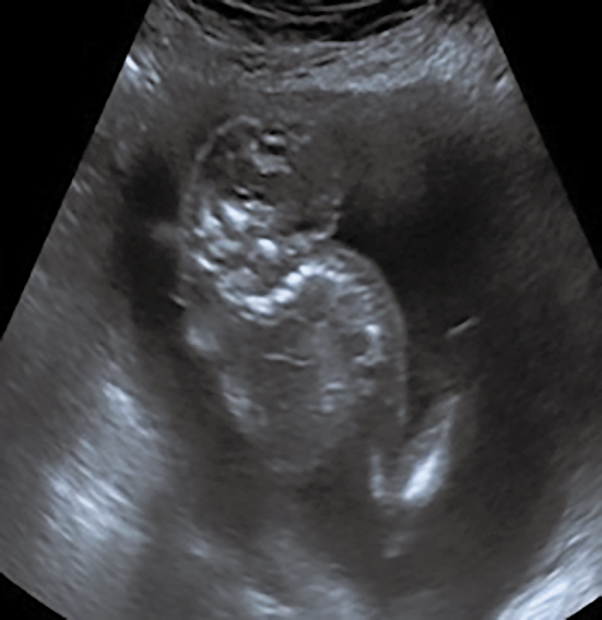Neural Tube Defects in Fetus Exposed to Valproate.