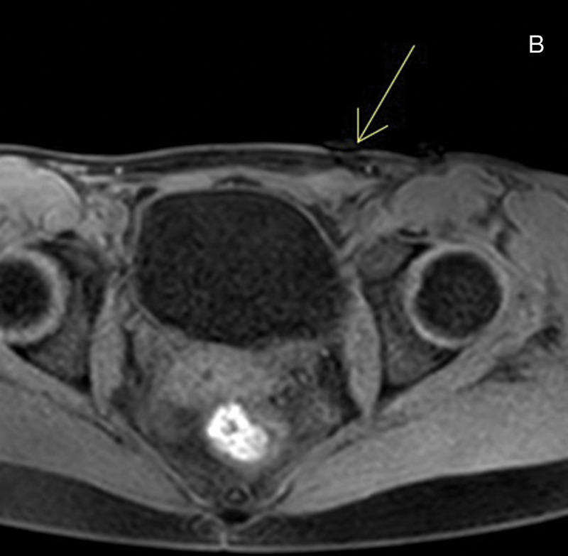 Endometriosis of the Round Ligaments in Twins: A Rare and Unique Presentation.