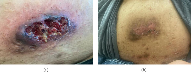 Secukinumab Leading to Rapid Improvement in Pyogenic Arthritis, Acne, Pyoderma Gangrenosum, and Hidradenitis Suppurativa (PAPASH) Syndrome: A Case Report and Review of Treatment Modalities for PAPASH Patients.