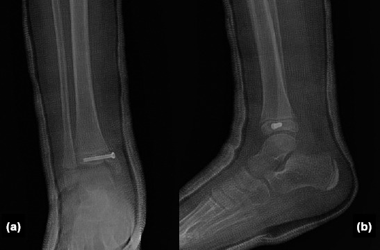 Clinical and radiological outcomes of surgically treated medial malleolus fractures in skeletally immature patients.